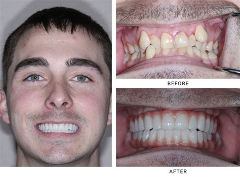 full arch dental implants ocala fl